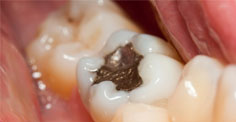 dentist harare tooth fillings